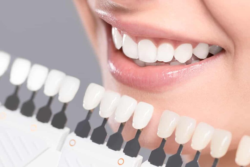Three Reasons You Need To Switch To Whitening Trays